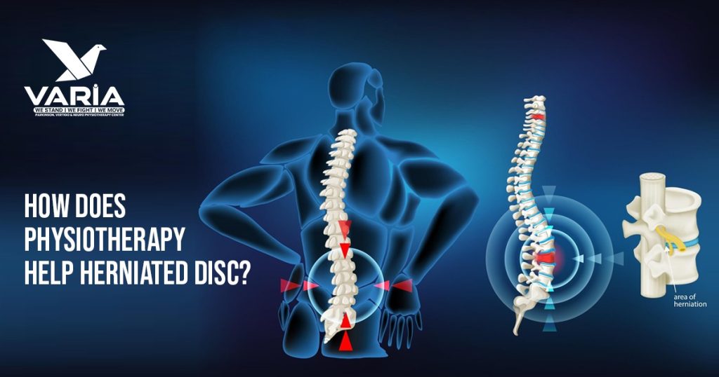 How Does Physiotherapy Help Herniated Disc